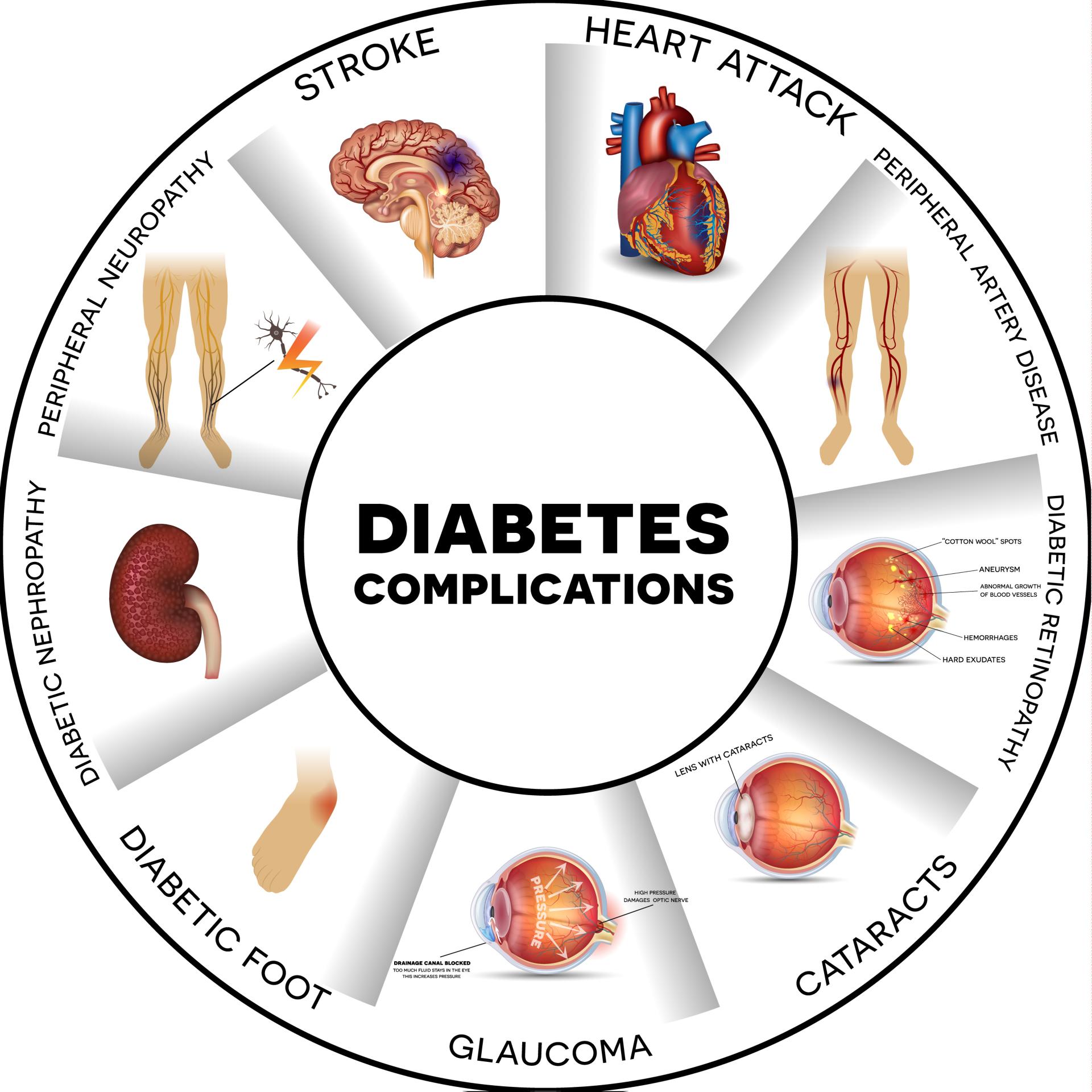 Diabete complication